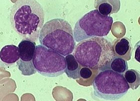Leukaemia