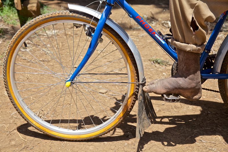 Legs and feet of a person with podoconiosis riding a bike