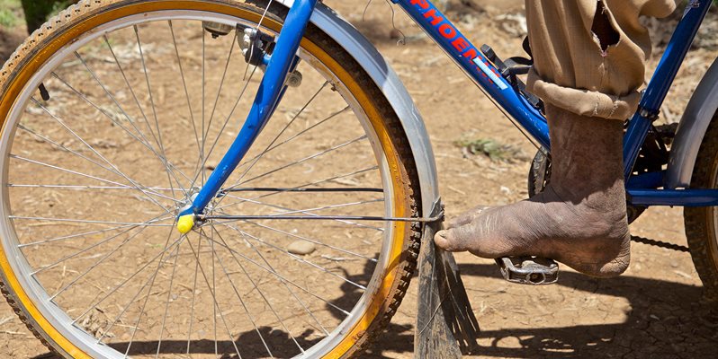 Person's foot with podoconiosis, on bike