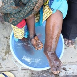 Washing feet with Podo symptoms in a blue plastic bowl