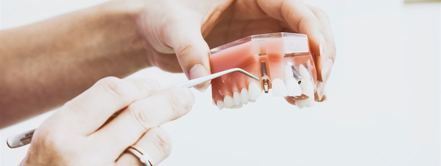 Hands holding a dental implants and teeth model