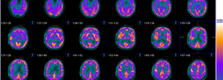 PET-CT axial scan of the brain, showing multiple images of the brain using nuclear medicine imaging