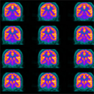 PET (positron emission tomography) scan of the brain