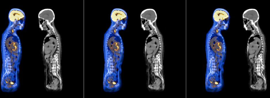 PET CT Scan image of whole body and CT scan Comparison in Sagittal plane of patient cancer disease