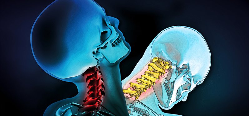 Illustrated image for a skeleton showing hi lighted pressure on the spinal cord in the neck