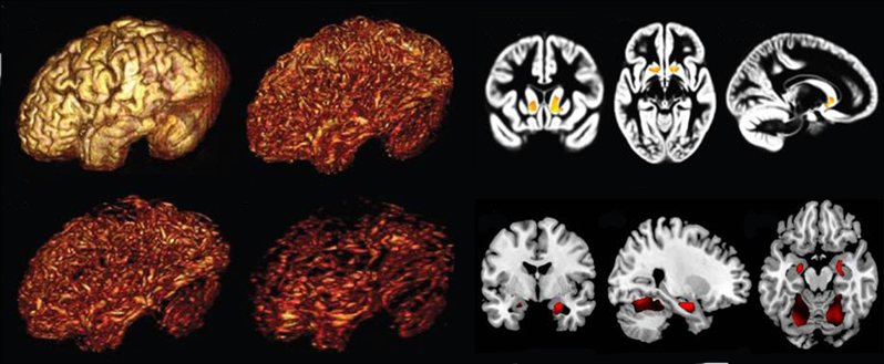 brainscans