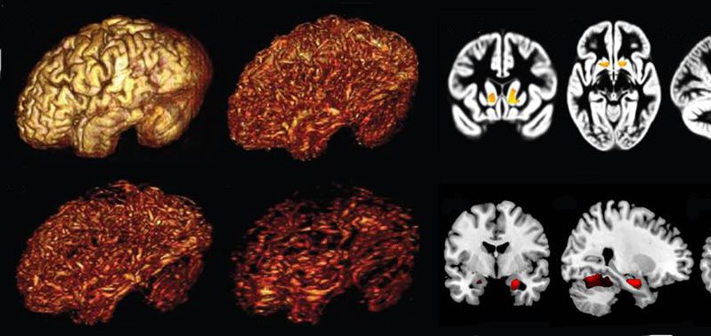 brainscans