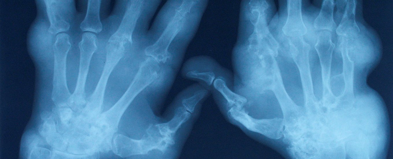 x-ray showing bones in hands