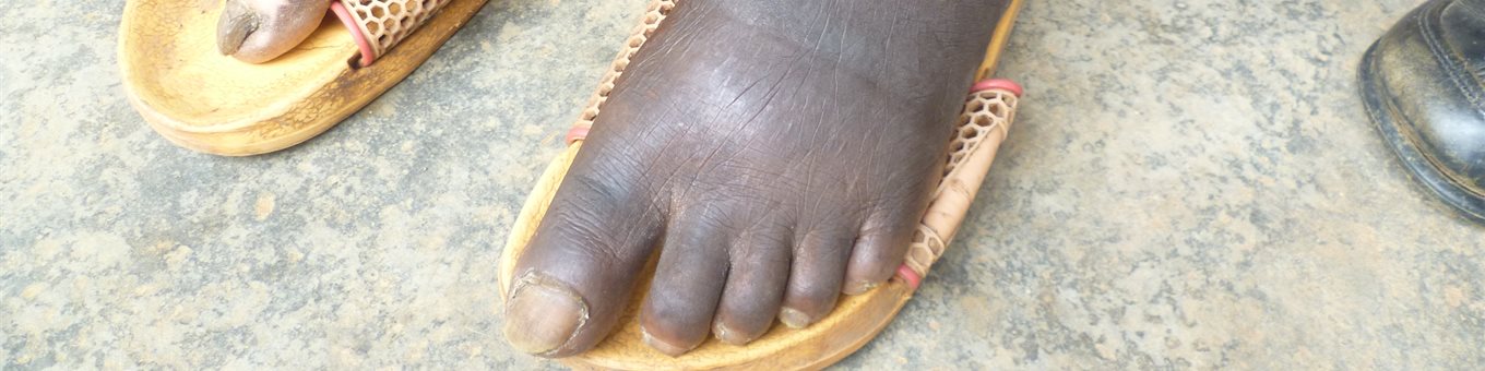 Feet in yellow sandals showing Podo symptoms