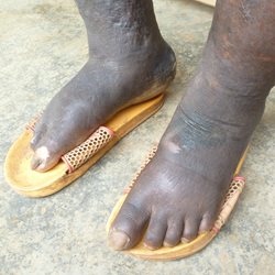 Feet in yellow sandals showing Podo symptoms