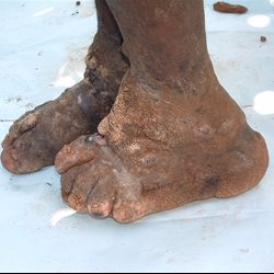 Feet showing Podo Symptoms