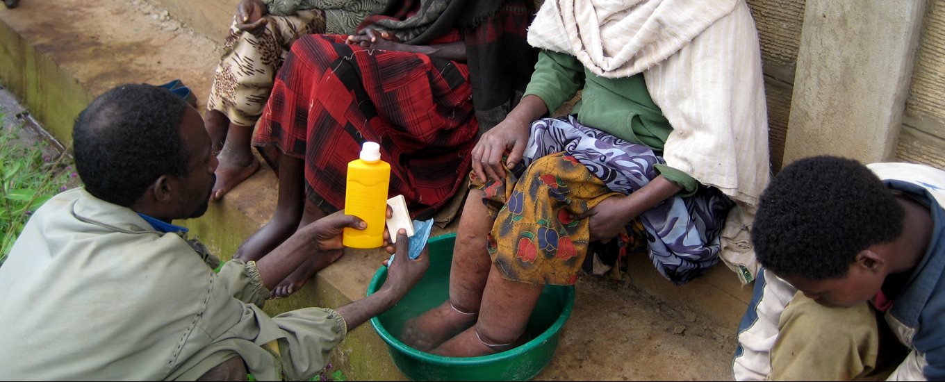 Bathing the feet of a patient with podoconiosis