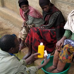 Podoconiosis Treatment by soaking the feet