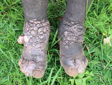 A close up of a podoconiosis patient's feet and legs