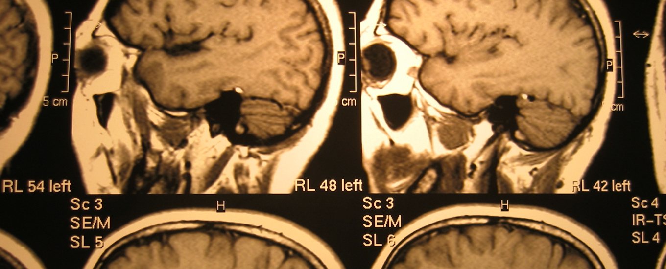 A black and white series of a set of brain scans