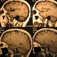 A set of brain scans