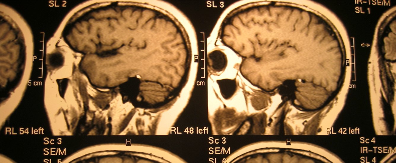 A set of yellow and black brain scan images